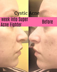 Super Acne Fighter / Organic Acne Serum